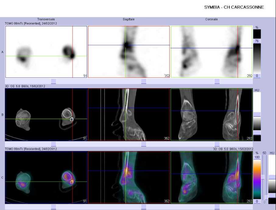 Fracture de la fibula gauche