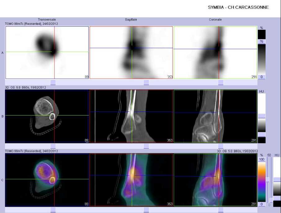 Fracture de la fibula gauche