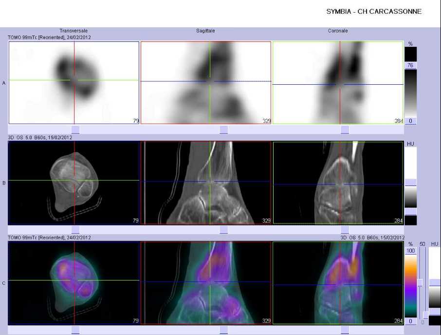Fracture du rebord post&eacute;rieur du pilon tibial gauche