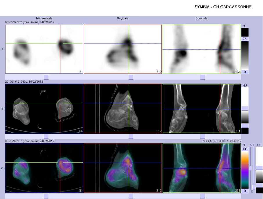 Probable fracture de la mall&eacute;ole tibiale 