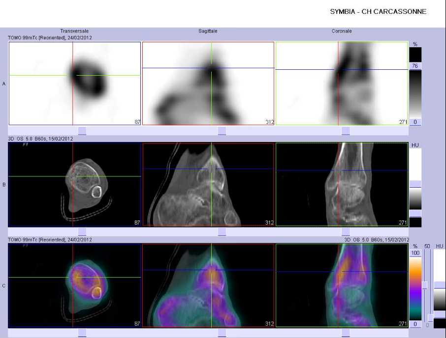 Probable fracture de la mall&eacute;ole tibiale 