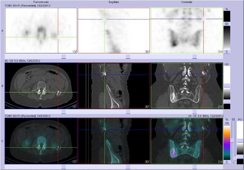 Probable h&eacute;matome calcifi&eacute; lombaire gauche