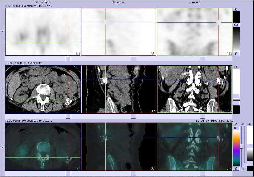 Probable h&eacute;matome calcifi&eacute; lombaire gauche