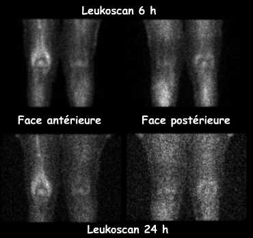 Scintigraphie au Leukoscan