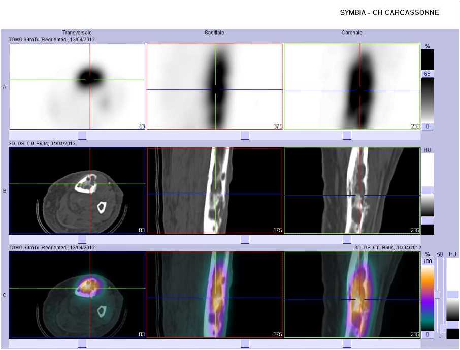 Ost&eacute;olyse du tibia gauche