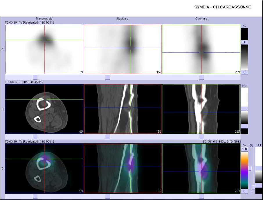 Ost&eacute;olyse corticale du tibia droit