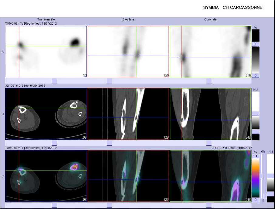 Ost&eacute;olyse corticale du tibia droit
