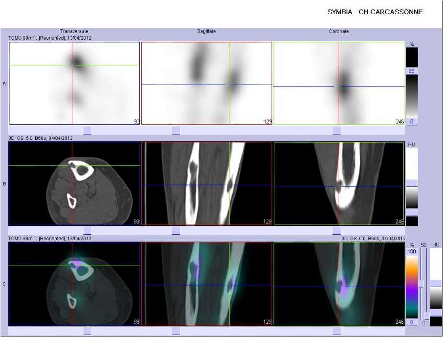 Ost&eacute;olyse corticale du tibia droit