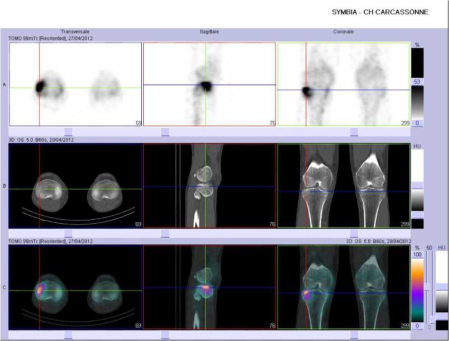 Fracture du plateau tibial lat&eacute;ral droit