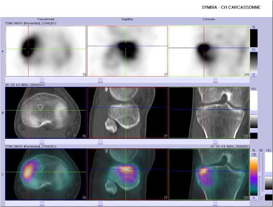 Fracture du plateau tibial lat&eacute;ral droit