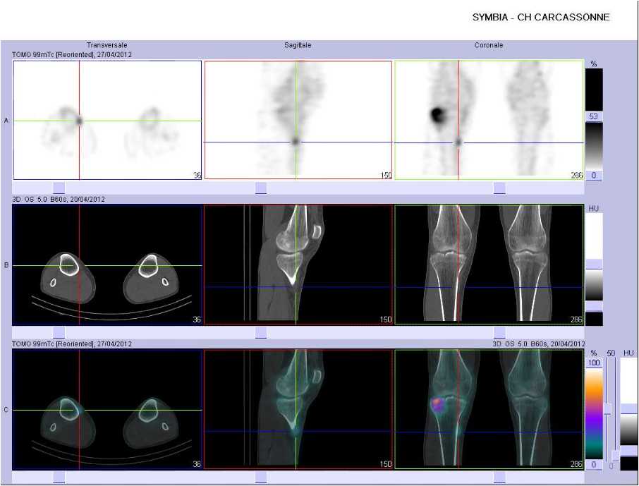 L&eacute;sion traumatique d'une insertion ligamentaire ou tendineuse