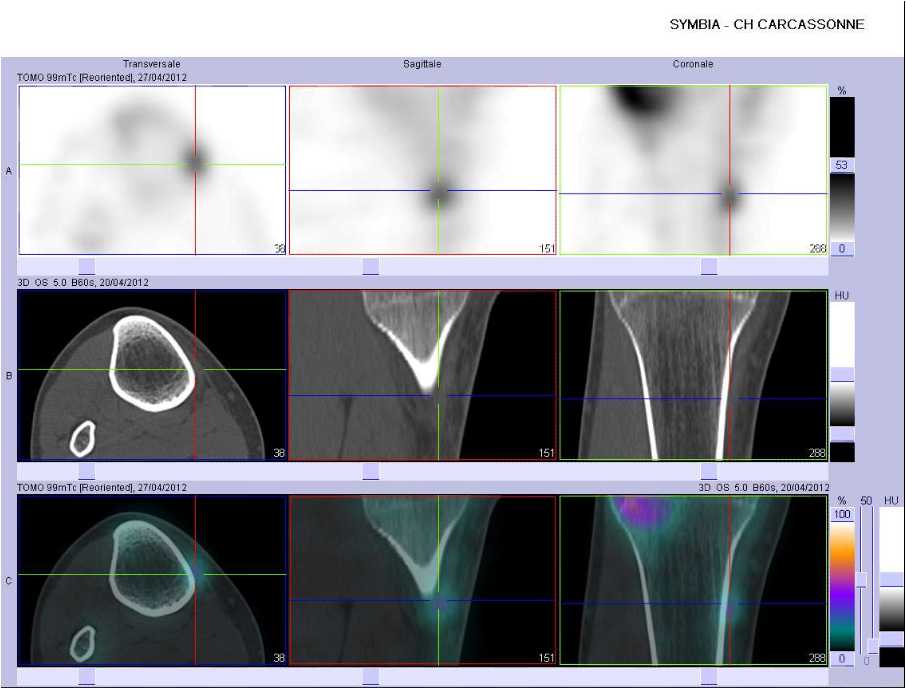 L&eacute;sion traumatique d'une insertion ligamentaire ou tendineuse
