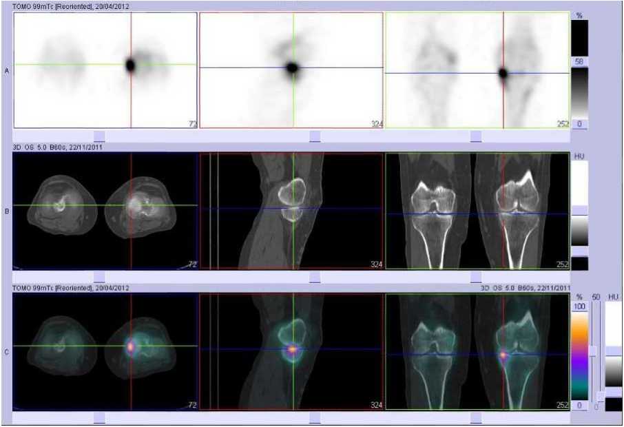 Fracture par insuffisance osseuse du plateau tibial m&eacute;dial gauche