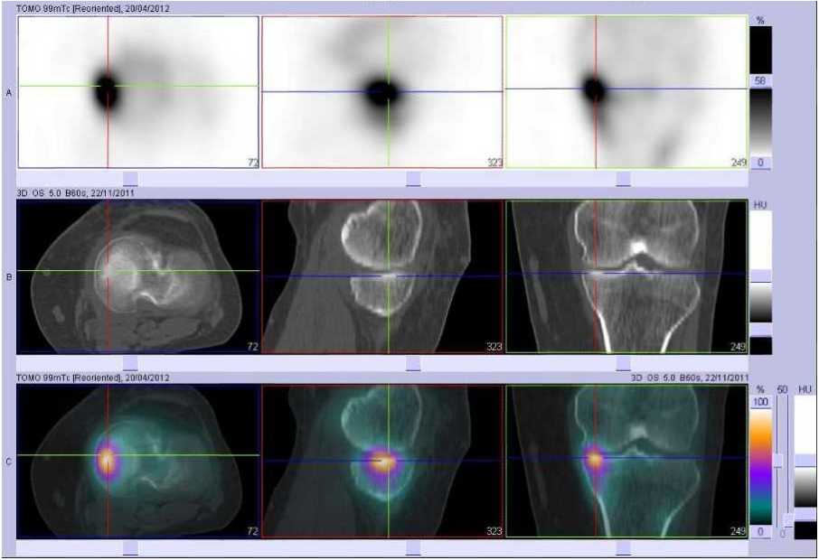 Fracture par insuffisance osseuse du plateau tibial m&eacute;dial gauche