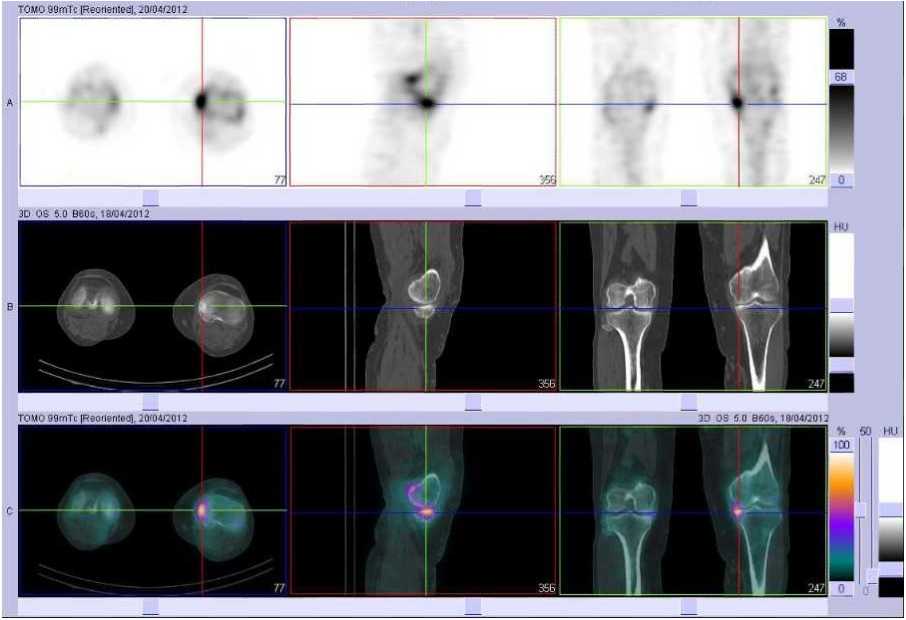 Fracture par insuffisance osseuse du plateau tibial m&eacute;dial gauche