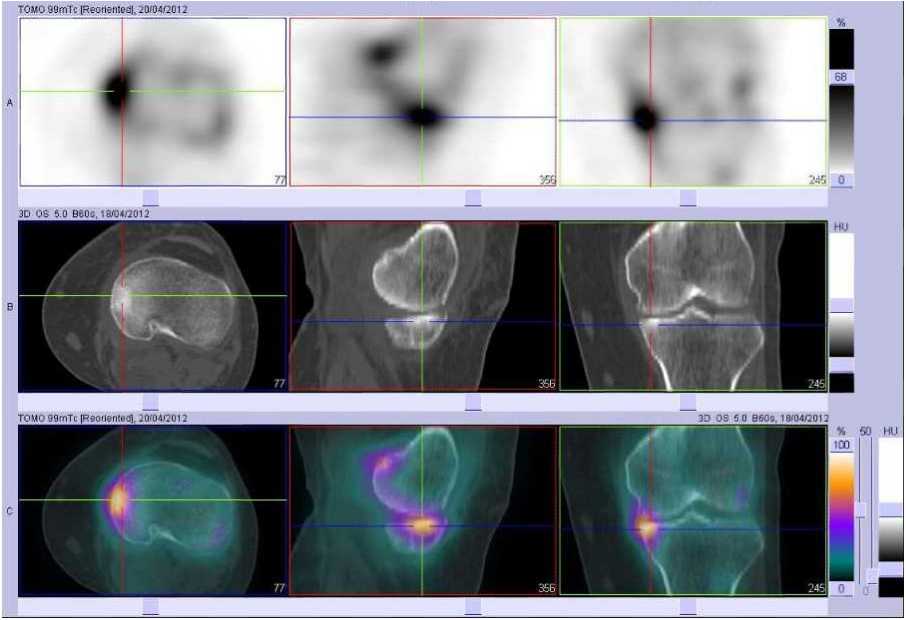 Fracture par insuffisance osseuse du plateau tibial m&eacute;dial gauche