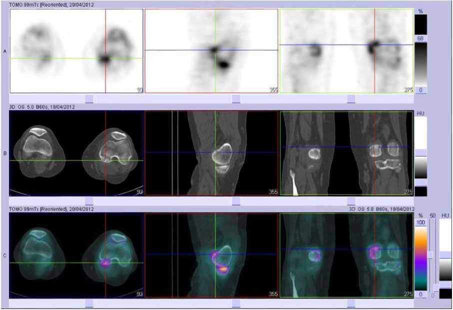 Tendinopathie sus et r&eacute;trocondylienne m&eacute;diale gauche