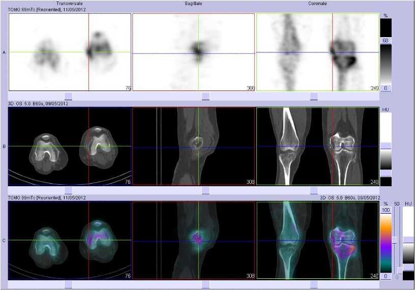Arrachement du ligament collat&eacute;ral m&eacute;dial gauche