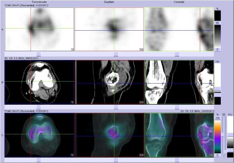 Arrachement du ligament collat&eacute;ral m&eacute;dial gauche