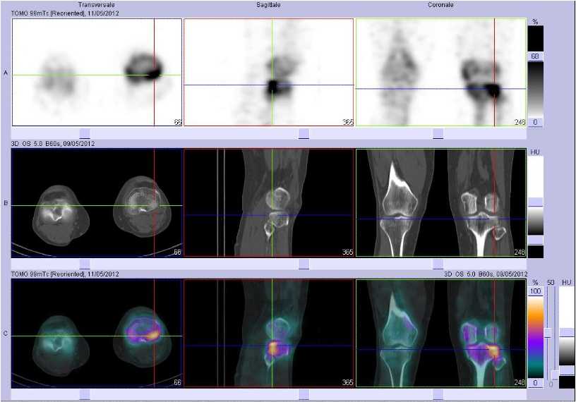 Fracture du rebord post&eacute;rieur du plateau tibial lat&eacute;ral gauche