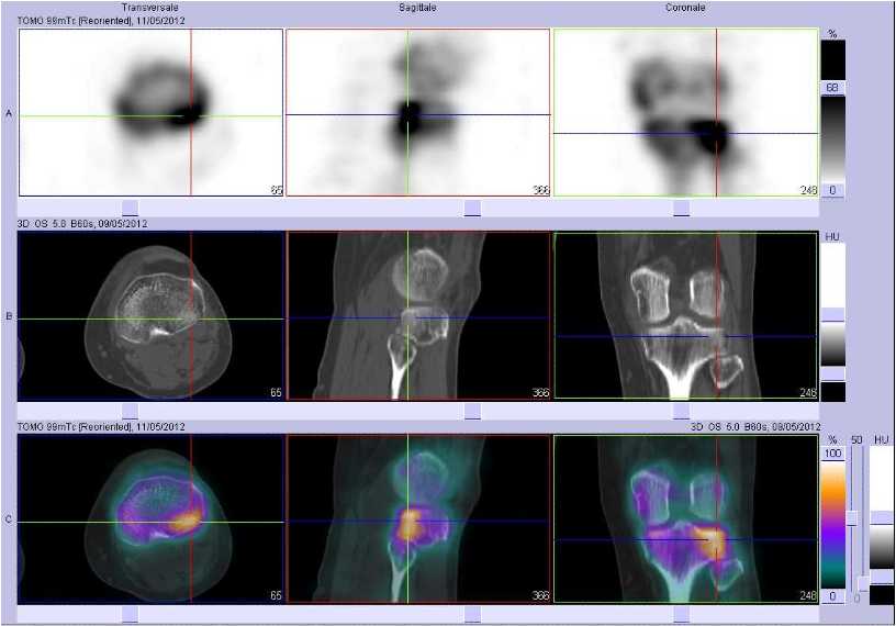 Fracture du rebord post&eacute;rieur du plateau tibial lat&eacute;ral gauche