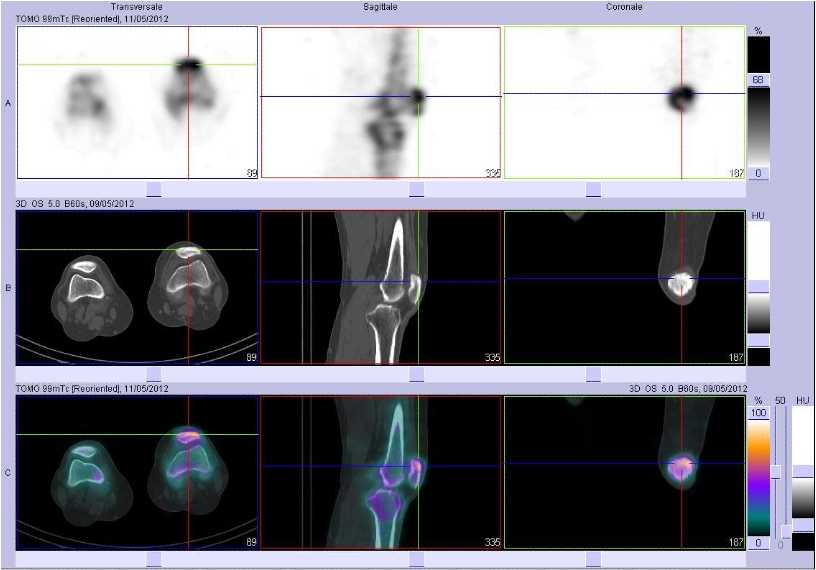 Tendinopathie d'insertion rotulienne et de la tub&eacute;rosit&eacute; tibiale ant&eacute;rieure du c&ocirc;t&eacute; gauche