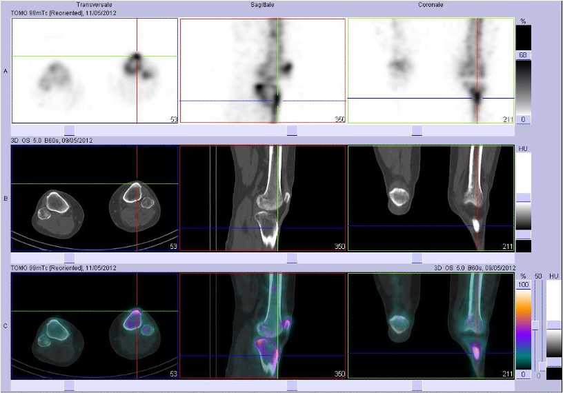 Tendinopathie d'insertion rotulienne et de la tub&eacute;rosit&eacute; tibiale ant&eacute;rieure du c&ocirc;t&eacute; gauche