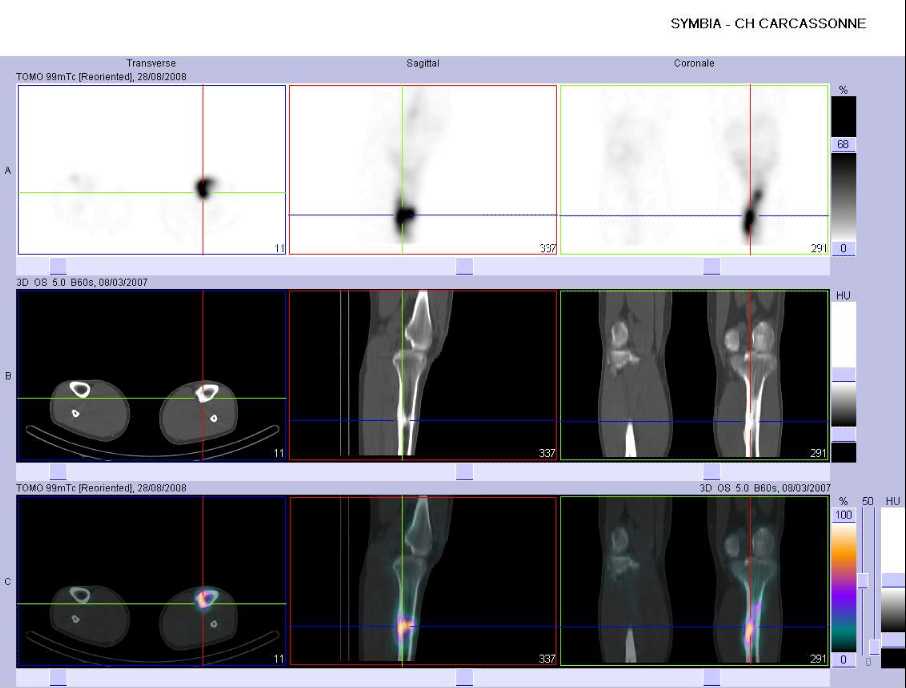 Fracture de fatigue du tiers sup&eacute;rieur du tibia gauche