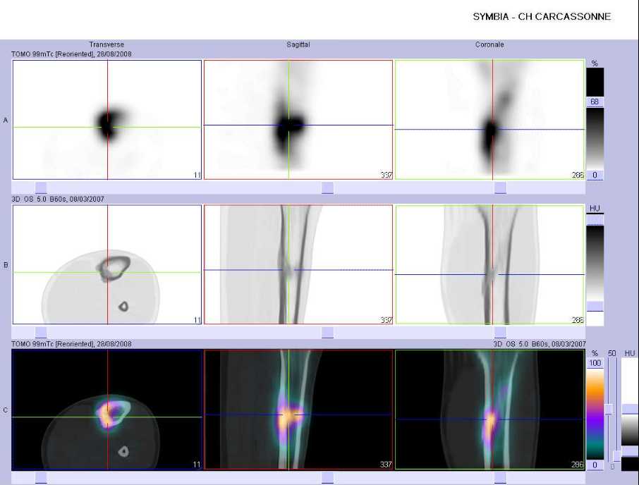 Fracture de fatigue du tiers sup&eacute;rieur du tibia gauche