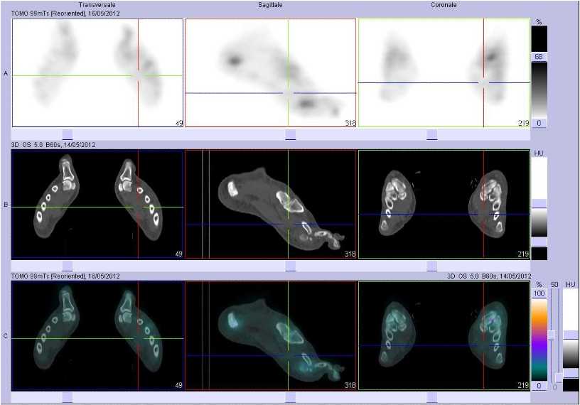 Cellulite sous-cutan&eacute;e de l'avant-pied gauche
