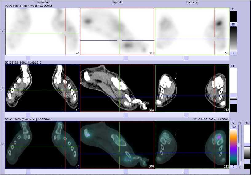 Cellulite sous-cutan&eacute;e de l'avant-pied gauche