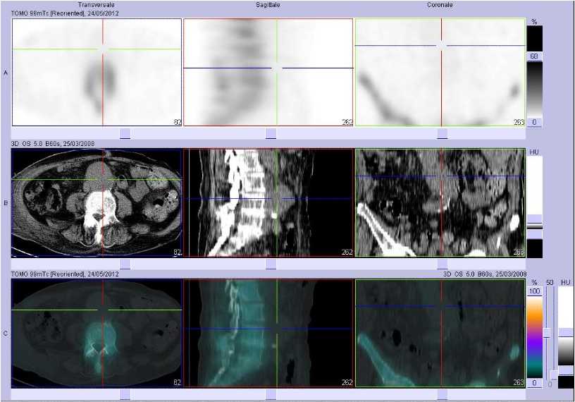An&eacute;vrisme de l'aorte abdominale
