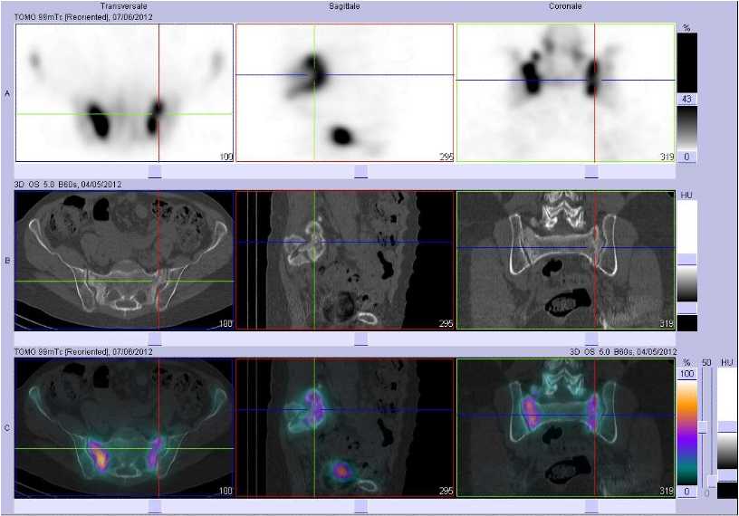 Fracture en H du sacrum