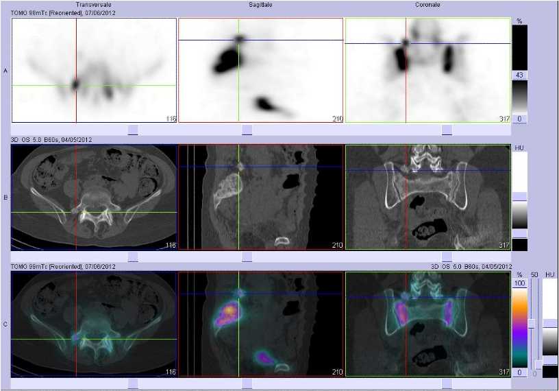 Fracture de l'apophyse transverse droite de L5