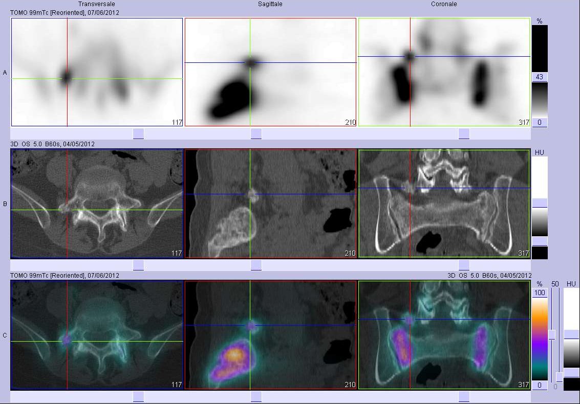 Fracture de l'apophyse transverse droite de L5