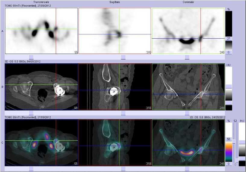 Possible fracture de la branche iliopubienne gauche