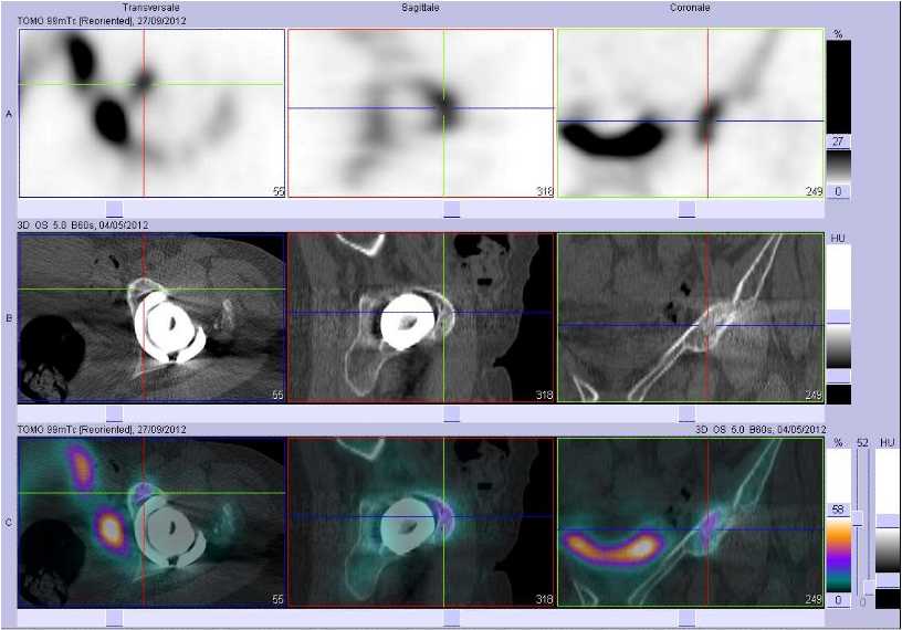 Possible fracture de la branche iliopubienne gauche