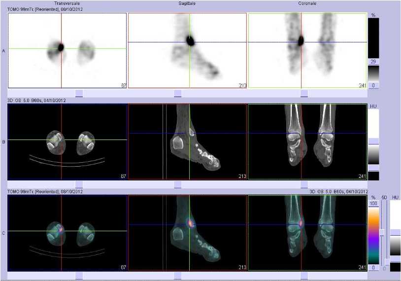 Tendinopathie d'insertion du ligament collat&eacute;ral m&eacute;dial de la cheville droite