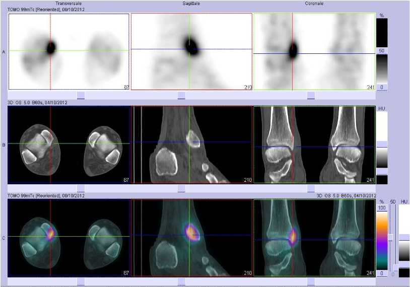 Tendinopathie d'insertion du ligament collat&eacute;ral m&eacute;dial de la cheville droite