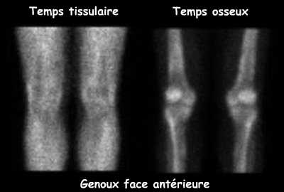 Temps tissulaire et temps osseux centr&eacute;s sur les genoux