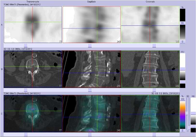 Aspect lytique du corps vert&eacute;bral de L4
