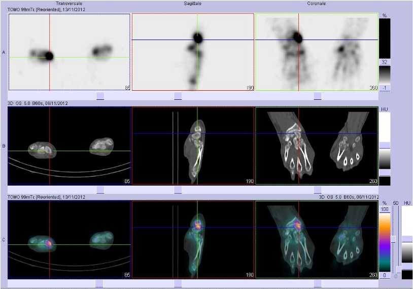 Fracture du scapho&iuml;de droit