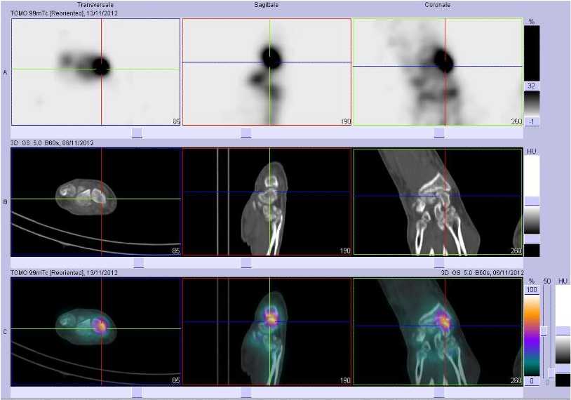 Fracture du scapho&iuml;de droit