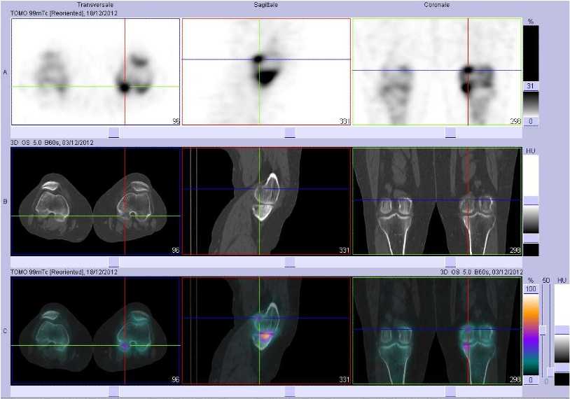 Tendinopathie sus et r&eacute;tro-condylienne m&eacute;diale gauche