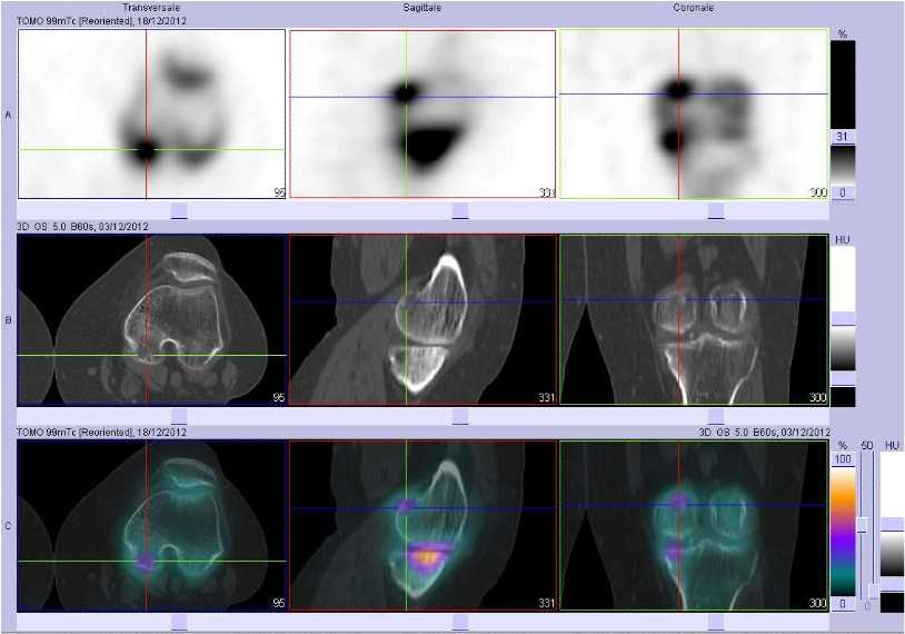 Tendinopathie sus et r&eacute;tro-condylienne m&eacute;diale gauche