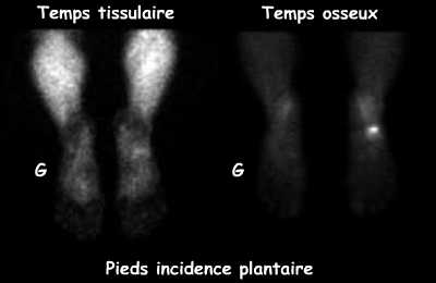 Pieds en incidence plantaire - Temps tissulaire et temps osseux