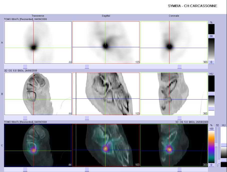 Fracture du tubercule post&eacute;rieur du cubo&iuml;de droit