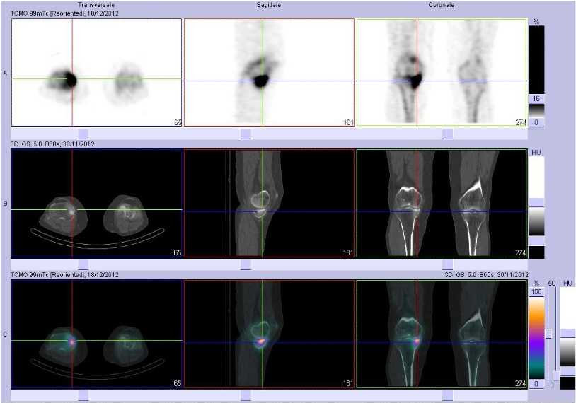 Fracture sous-chondrale du plateau tibial m&eacute;dial droit