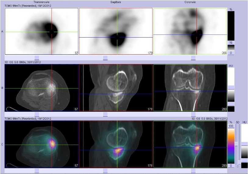 Fracture sous-chondrale du plateau tibial m&eacute;dial droit