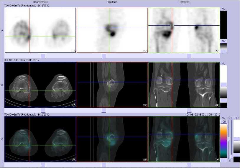 Tendinopathie sus et r&eacute;trocondylienne  droite